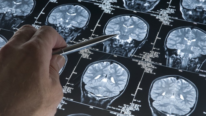 Logran parar el crecimiento de células tumorales cerebrales Logran parar el crecimiento de células tumorales cerebrales